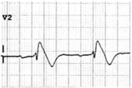 Brugada type 1